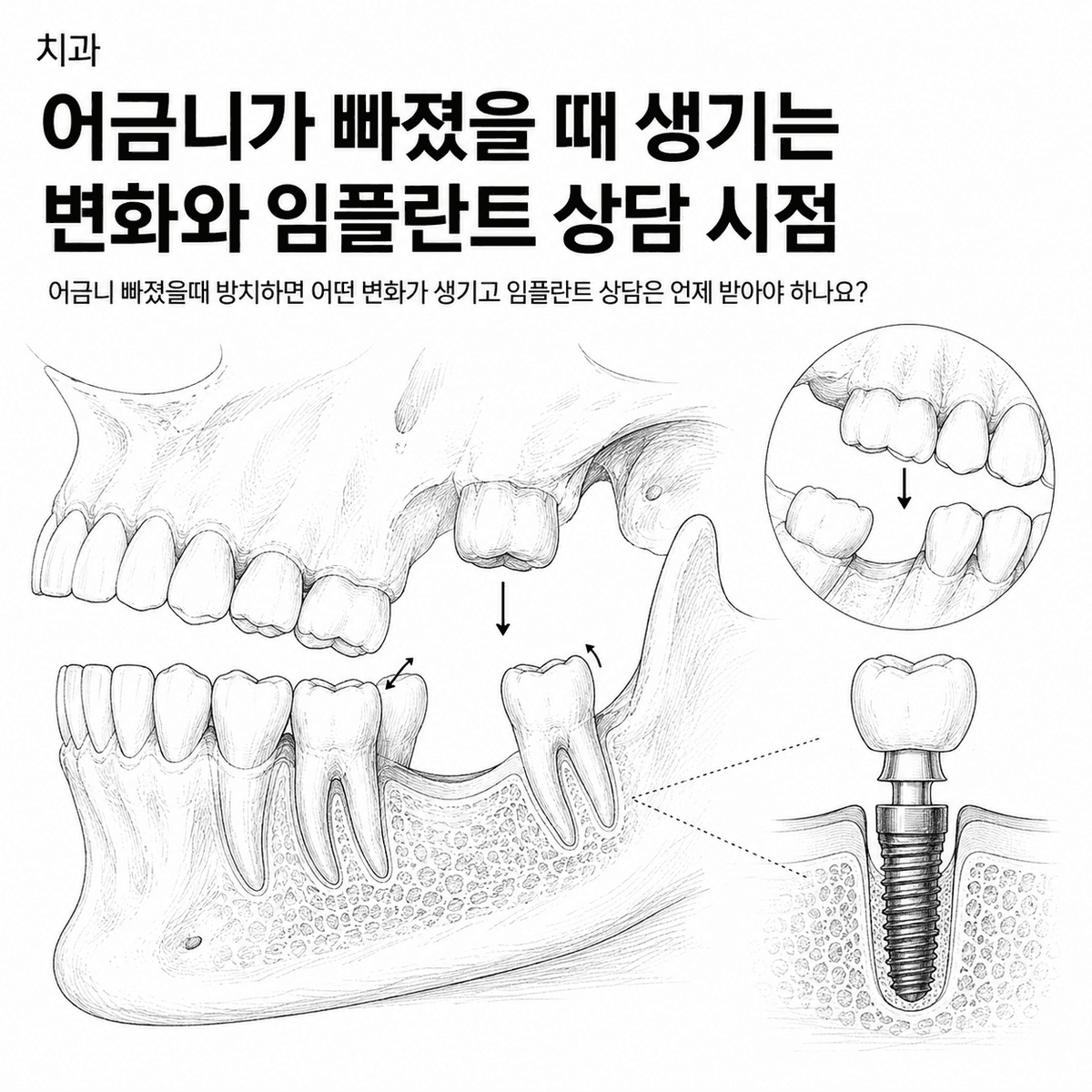 서울 치과 어금니가 빠졌을 때 생기는 변화와 임플란트 상담 시점 핵심 정보 이미지